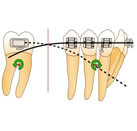 Mini-vis : l'orthodontie de demain