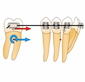 Biomécanique de la mésialisation molaire inférieure sur mini-vis en technique multi-attache vestibulaire