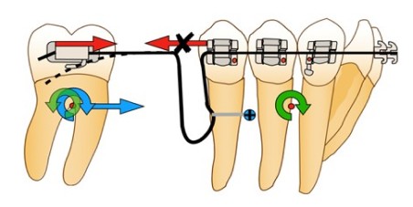Biomécanique de la mésialisation molaire inférieure sur mini-vis en technique multi-attache vestibulaire